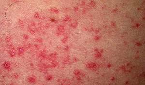 аллергический дерматит симптомы и лечение у взрослых