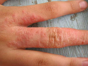 аллергический дерматит  симптомы и лечение у взрослых