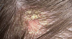 себорейный дерматит волосистой части головы
