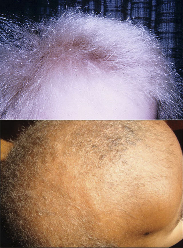 Монилетрикс или веретенообразная атрофия волос