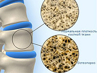 остеопения