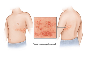 опоясывающий лишай заразен или нет