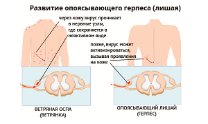 опоясывающий лишай заразен или нет