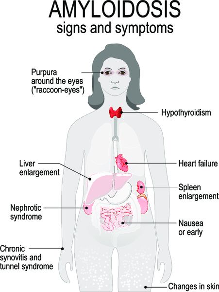 Амилоидоз сердца: причины, особенности течения и лечения