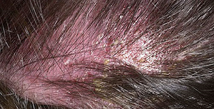 себорейный дерматит волосистой части головы лечение