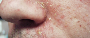 себорейный дерматит на лице