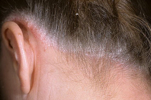себорейный дерматит волосистой части головы