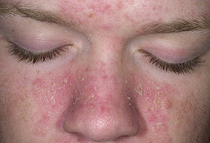 себорейный дерматит на лице