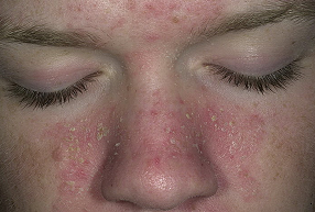 себорейный дерматит на лице лечение