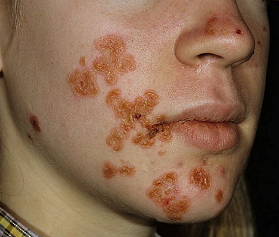 импетиго что это такое