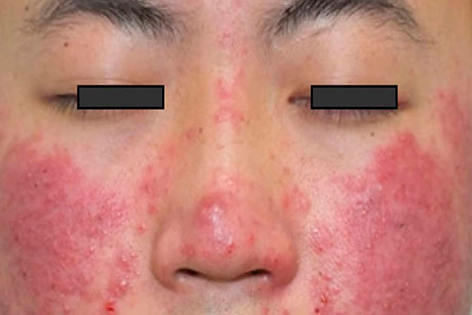 Подкожный клещ на лице: симптомы, лечение