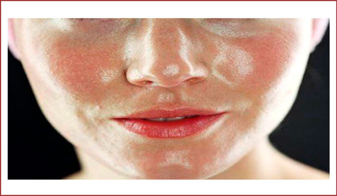 Подкожный клещ на лице: симптомы, лечение