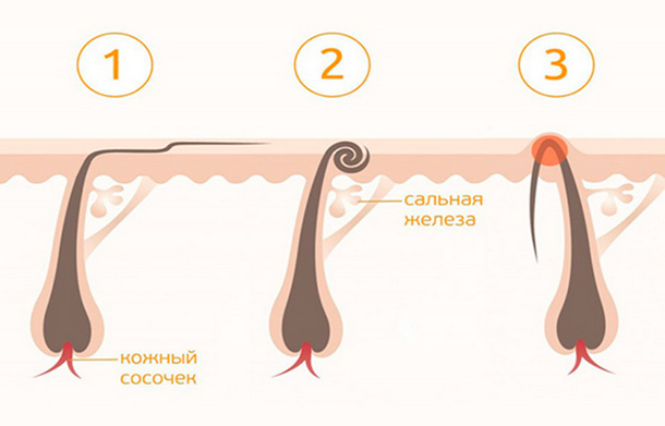 Врастание волос