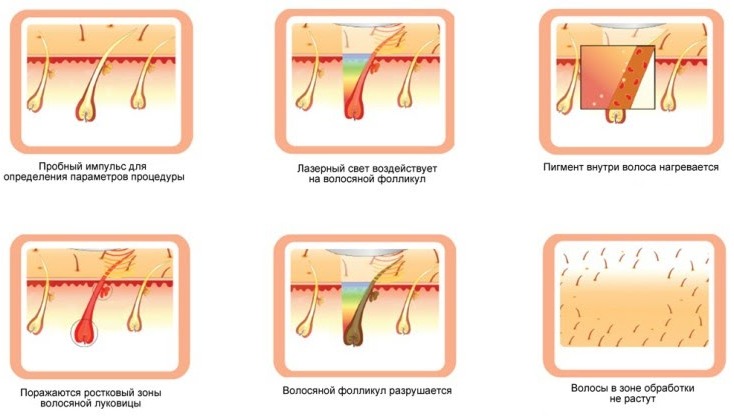 Принцип проведения лазерной эпиляции 