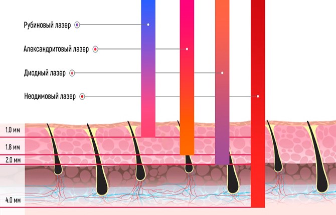 Виды, возможности лазеров для эпиляции
