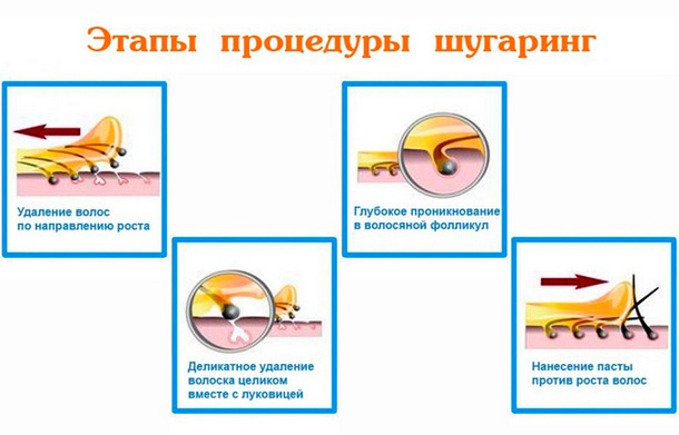 Этапы процедуры шугаринг